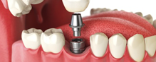 Dentist specializing in cosmetic dental implants in Astoria, NY